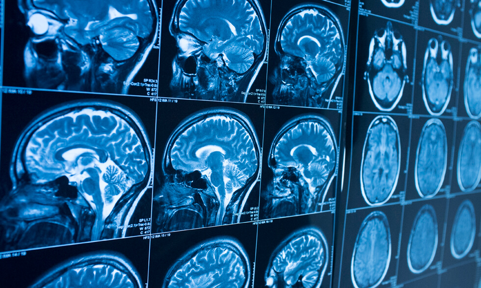 Neurofeedback en individuos con altas capacidades. Técnicas y estrategias para acompañar y favorecer un correcto equilibrio de su actividad cerebral para potenciar su talento y rendimiento.