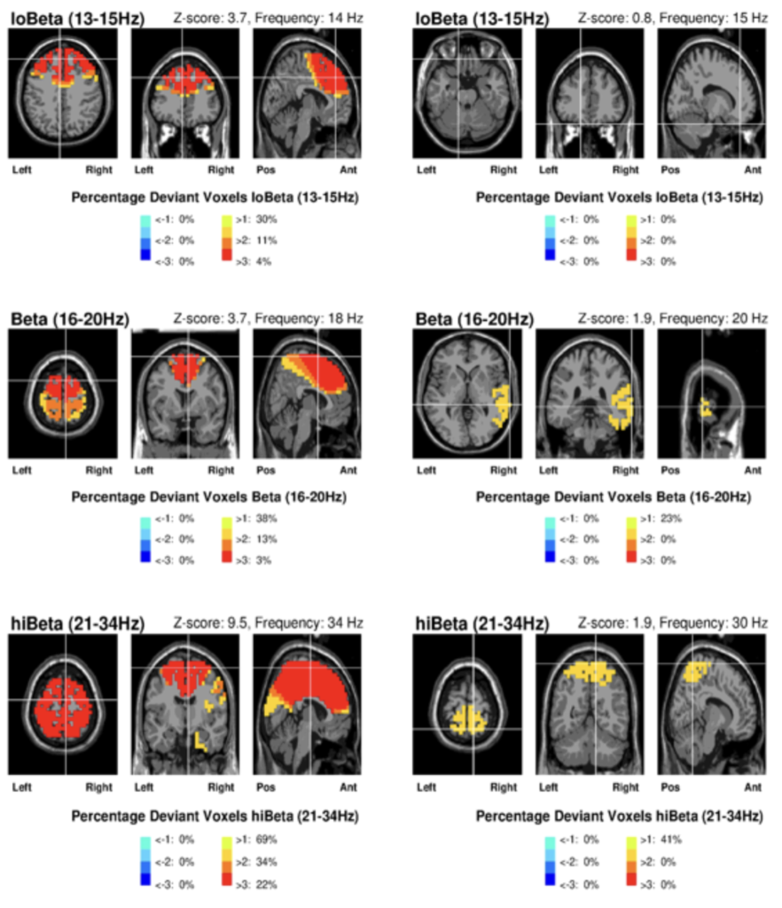 casos reales neurofeedback para autismo ninos con TEA 2