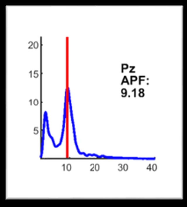 Espectro EEG en Pz con frecuencia pico alfa de 9,18 Hz en una clienta con burnout severo, antes del neurofeedback